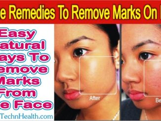 Natural Ways To Remove Marks From The Face