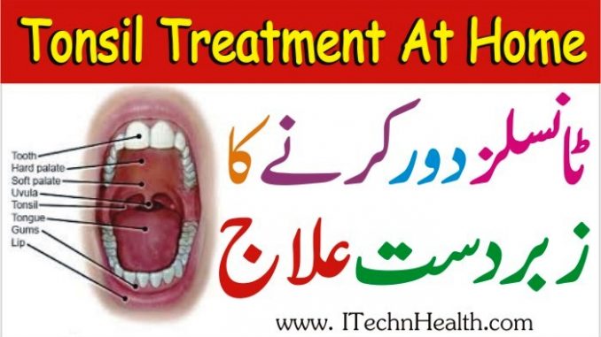 Tonsil Treatment At Home, Tonsils Ka Ilaj Ubqari