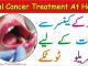 Oral Cancer Treatment, Oral Cancer Types & Oral Cancer Symptoms