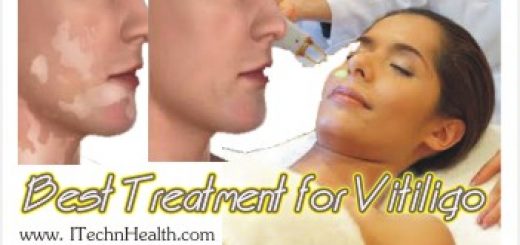 Best Treatment For Vitiligo