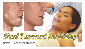 Best Treatment For Vitiligo