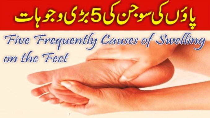 5 Reasons Of Swelling On The Feet