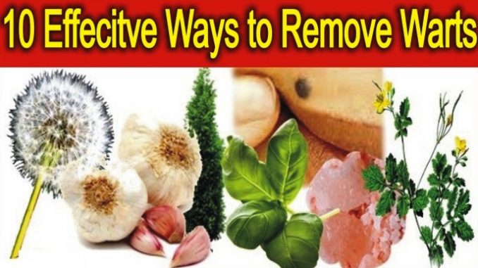 Ways to Remove Warts
