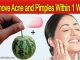 Herbal Remedy To Remove Acne and Pimples Within One Week