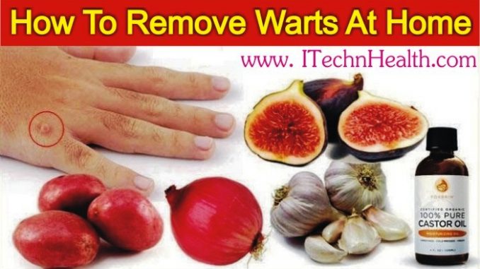 How To Remove Warts At Home