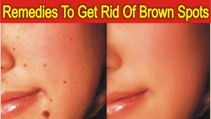 Natural Home Remedies To Get Rid Of Brown Spots And Warts From Face