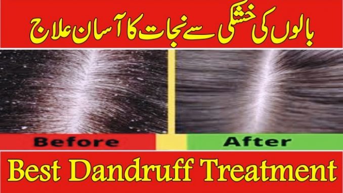 Dandruff Treatment In Urdu