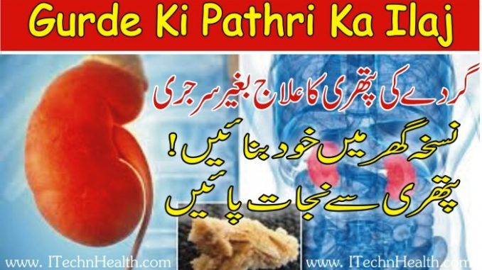 Gurde Ki Pathri Ka Ilaj In Urdu, Methods For Kidney Stone Removal