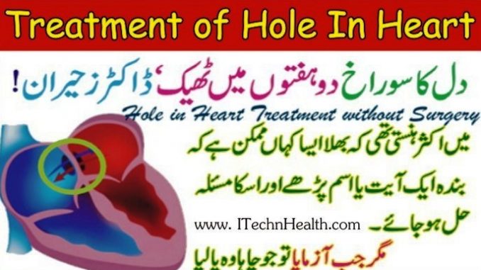 Treatment of Hole in Heart without Heart Surgery
