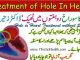 Treatment of Hole in Heart without Heart Surgery