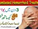 Thrombosed Hemorrhoid Treatment without Sitz Bath