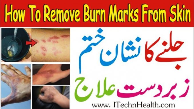 How To Remove Burn Marks From Skin Home Remedies