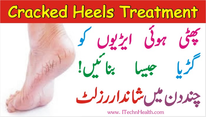 Home remedy for the pain of heels hot sale in urdu