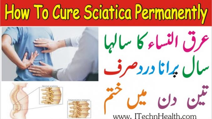 How To Cure Sciatica Permanently