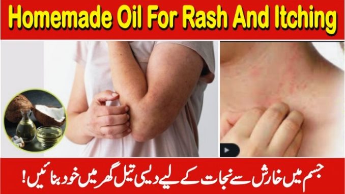 How To Stop Skin Itching, Oil For Rash And Itching In Urdu