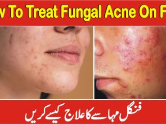 How To Treat Fungal Acne On Face, Fungus Ka Desi Ilaj In Urdu