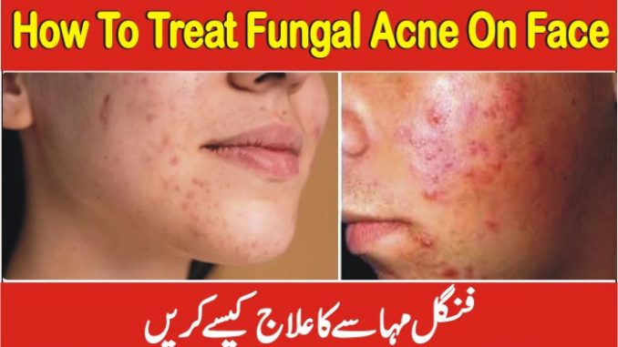 How To Treat Fungal Acne On Face, Fungus Ka Desi Ilaj In Urdu