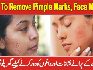 How To Remove Pimple Marks, Face Marks & Remove Acne Scars Naturally