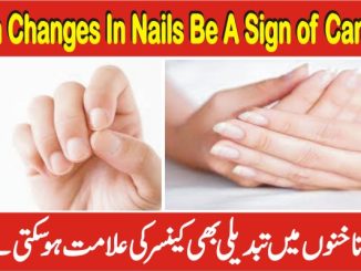 Signs Of Cancer In Fingernails, Can Changes In Nails Be A Sign Of Cancer