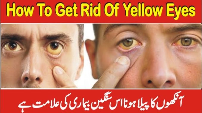 how to get rid of yellow eyes