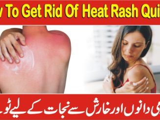 How To Get Rid Of Heat Rash Quickly