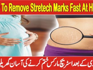 How To Remove Stretch Marks Fast At Home
